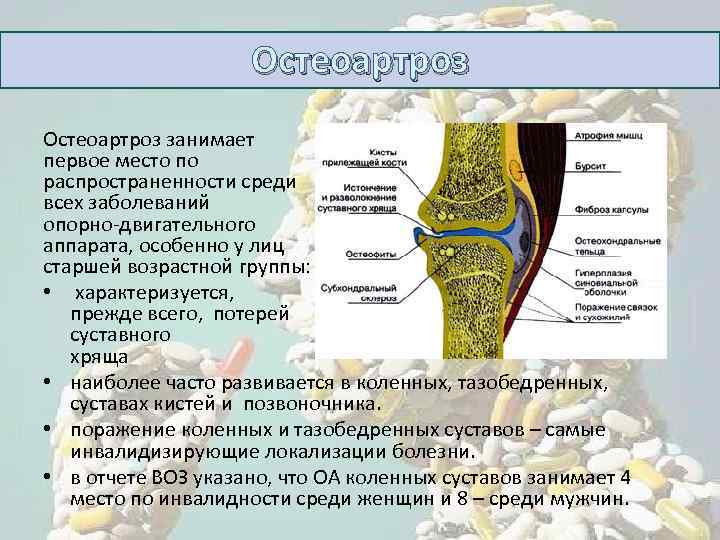 Остеоартроз занимает первое место по распространенности среди всех заболеваний опорно-двигательного аппарата, особенно у лиц