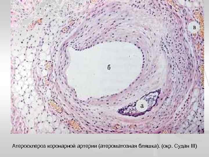Атеросклероз коронарной артерии (атероматозная бляшка). (окр. Судан ІІІ) 