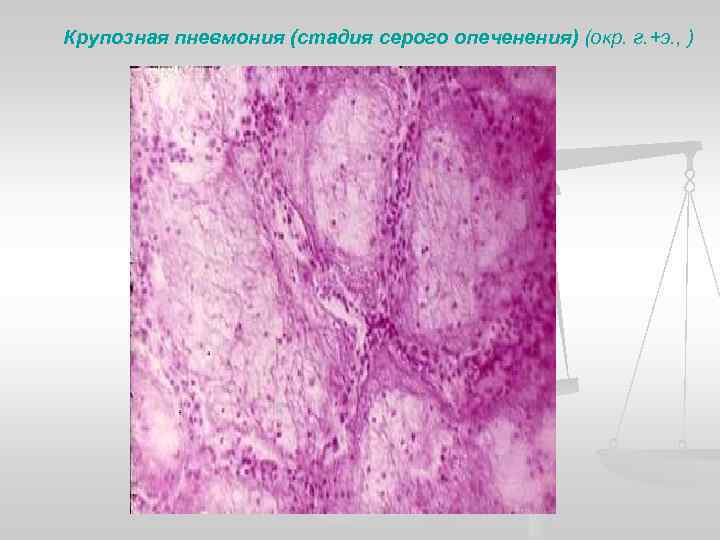 Крупозная пневмония (стадия серого опеченения) (окр. г. +э. , ) 