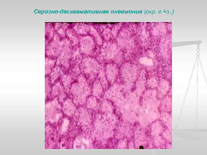 Серозно-десквамативная пневмония (окр. г. +э. , ) 