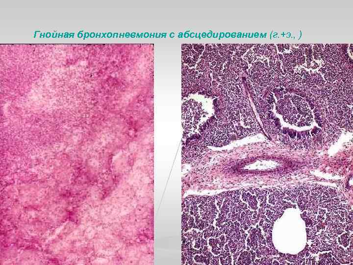Гнойная бронхопневмония с абсцедированием (г. +э. , ) 