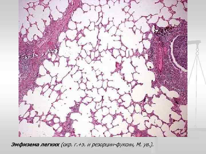 Эмфизема легких (окр. г. +э. и резорцин-фуксин, М. ув. ). 