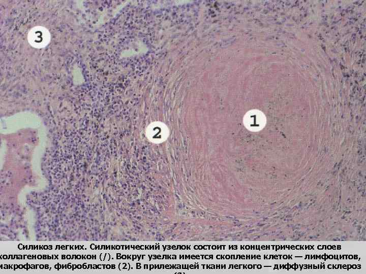 Силикоз легких. Силикотический узелок состоит из концентрических слоев коллагеновых волокон (/). Вокруг узелка имеется