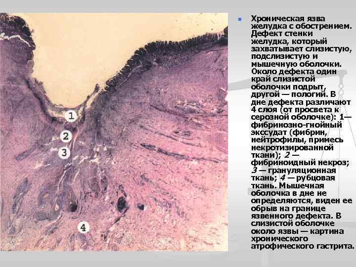 n Хроническая язва желудка с обострением. Дефект стенки желудка, который захватывает слизистую, подслизистую и