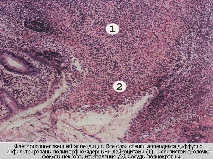 Флегмонозно-язвенный аппендицит. Все слои стенки аппендикса диффузно инфильтрированы полиморфно-ядерными лейкоцитами (1). В слизистой оболочке