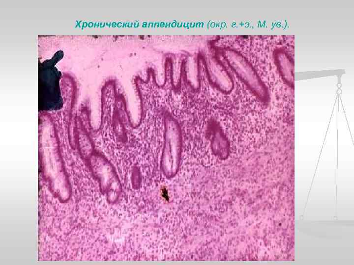 Хронический аппендицит (окр. г. +э. , М. ув. ). 