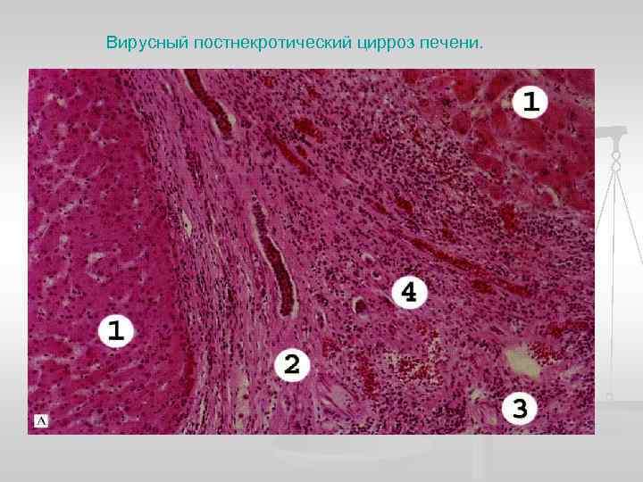 Вирусный постнекротический цирроз печени. 