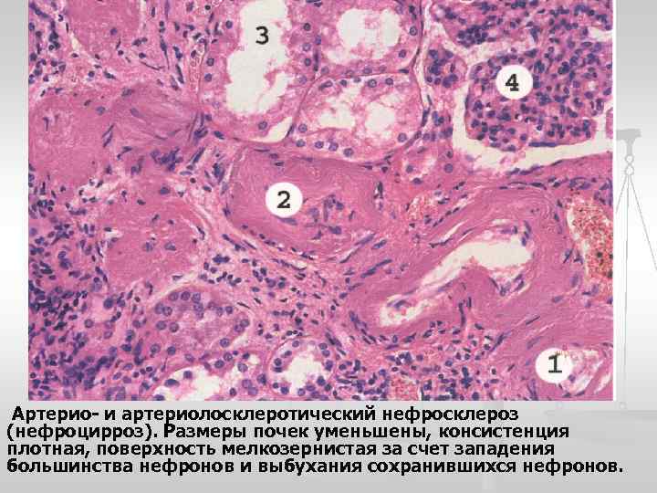 Артерио- и артериолосклеротический нефросклероз (нефроцирроз). Размеры почек уменьшены, консистенция плотная, поверхность мелкозернистая за счет