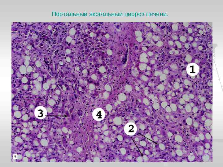 Портальный акогольный цирроз печени. 
