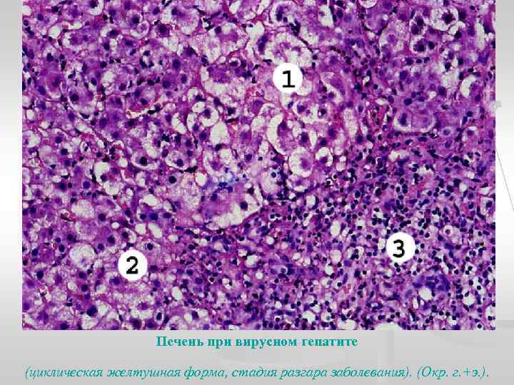 Печень при вирусном гепатите (циклическая желтушная форма, стадия разгара заболевания). (Окр. г. +э. ).