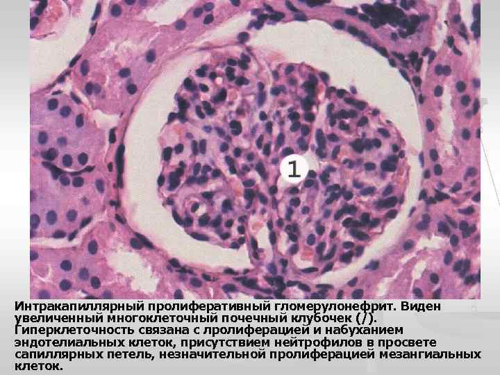 Интракапиллярный пролиферативный гломерулонефрит. Виден увеличенный многоклеточный почечный клубочек (/). Гиперклеточность связана с лролиферацией и