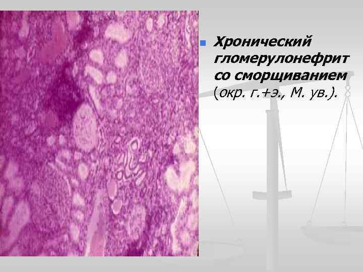 n Хронический гломерулонефрит со сморщиванием (окр. г. +э. , М. ув. ). 