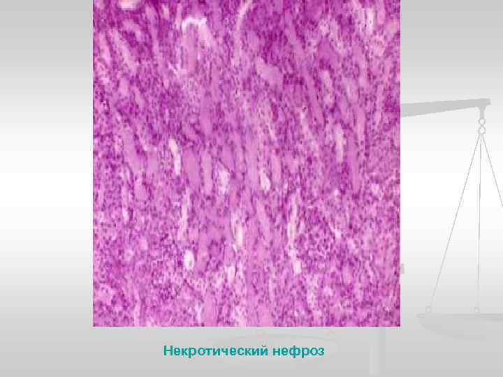 Некротический нефроз 