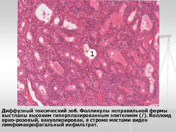 Диффузный токсический зоб. Фолликулы неправильной формы выстланы высоким гиперплазированным эпителием (/). Коллоид ярко-розовый, вакуолизирован,