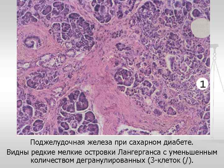 Поджелудочная железа при сахарном диабете. Видны редкие мелкие островки Лангерганса с уменьшенным количеством дегранулированных