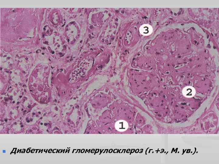 n Диабетический гломерулосклероз (г. +э. , М. ув. ). 