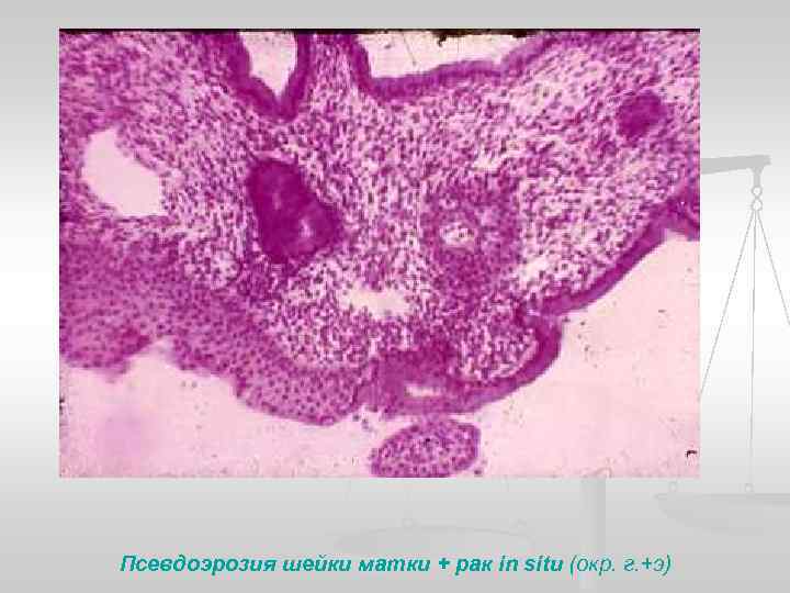 Псевдоэрозия шейки матки + рак in situ (окр. г. +э) 