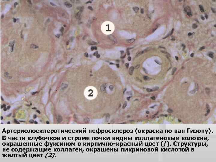 Артериолосклеротический нефросклероз микропрепарат рисунок