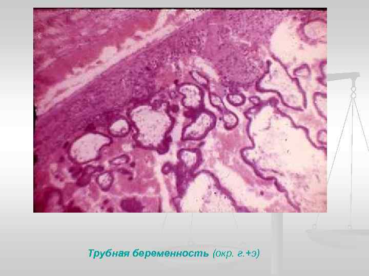 Трубная беременность (окр. г. +э) 