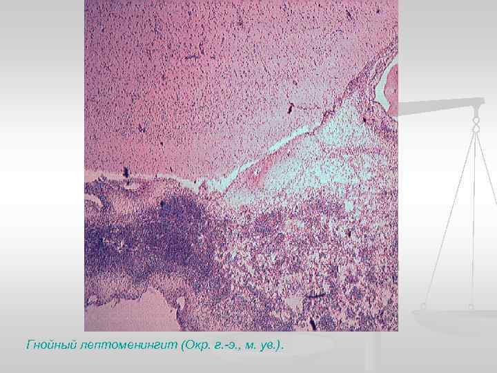 Гнойный лептоменингит (Окр. г. -э. , м. ув. ). 