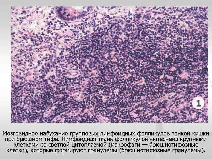 Мозговидное набухание групповых лимфоидных фолликулов тонкой кишки при брюшном тифе. Лимфоидная ткань фолликулов вытеснена