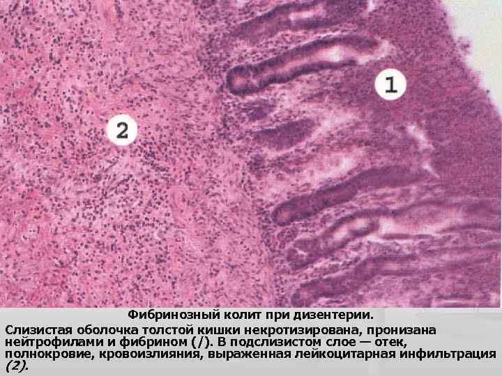 Фибринозный колит при дизентерии. Слизистая оболочка толстой кишки некротизирована, пронизана нейтрофилами и фибрином (/).