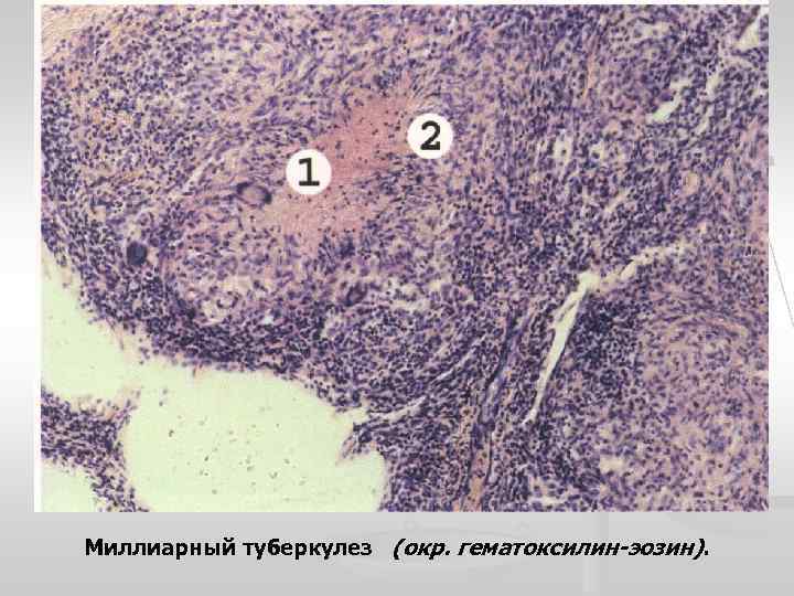 Миллиарный туберкулез (окр. гематоксилин-эозин). 