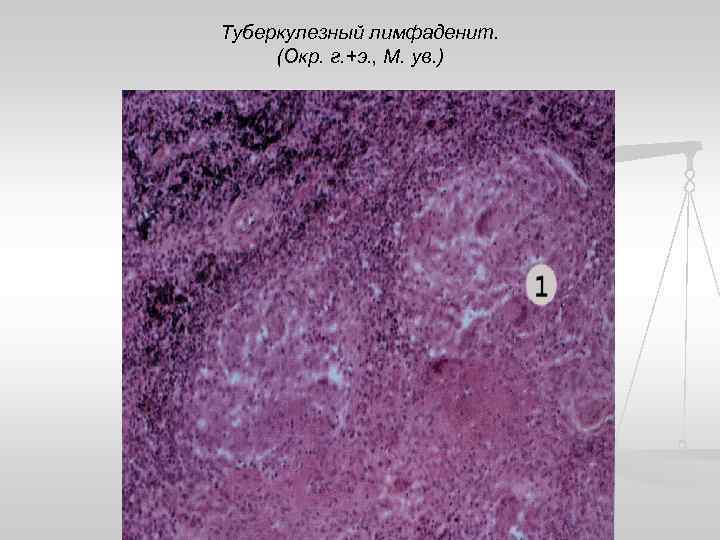 Туберкулезный лимфаденит. (Окр. г. +э. , М. ув. ) 