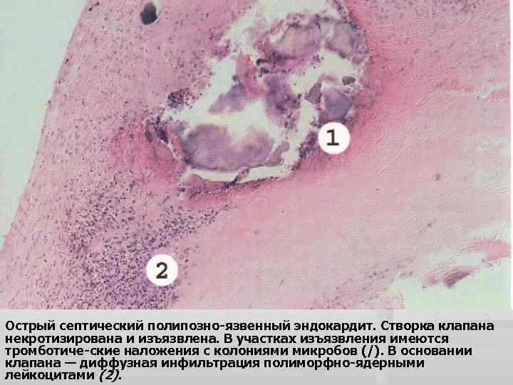 Острый септический полипозно-язвенный эндокардит. Створка клапана некротизирована и изъязвлена. В участках изъязвления имеются тромботиче-ские