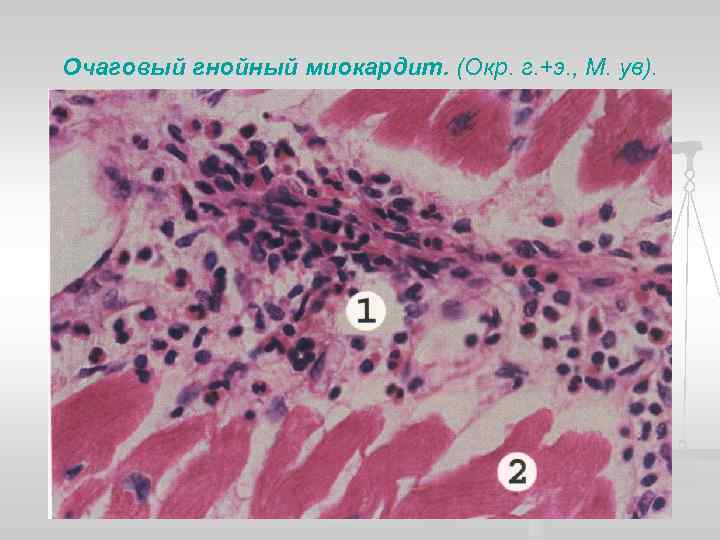 Очаговый гнойный миокардит. (Окр. г. +э. , М. ув). 