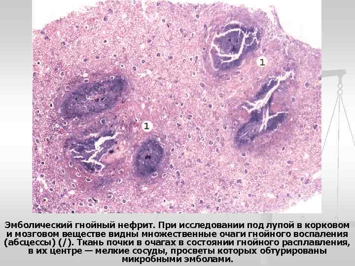 Эмболический гнойный нефрит. При исследовании под лупой в корковом и мозговом веществе видны множественные