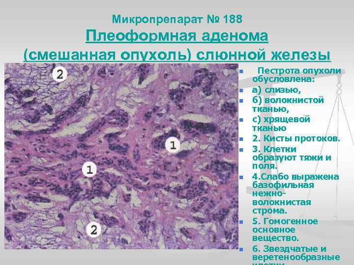 Микропрепарат № 188 Плеоформная аденома (смешанная опухоль) слюнной железы n n n n n