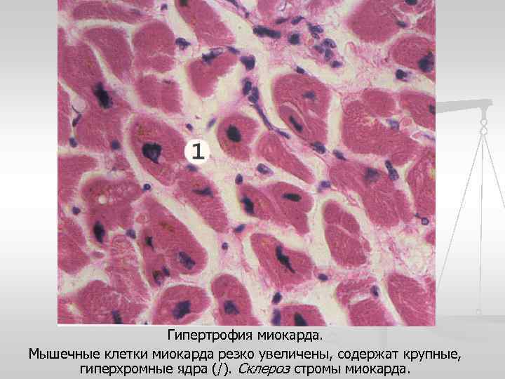 Гипертрофия миокарда. Мышечные клетки миокарда резко увеличены, содержат крупные, гиперхромные ядра (/). Склероз стромы