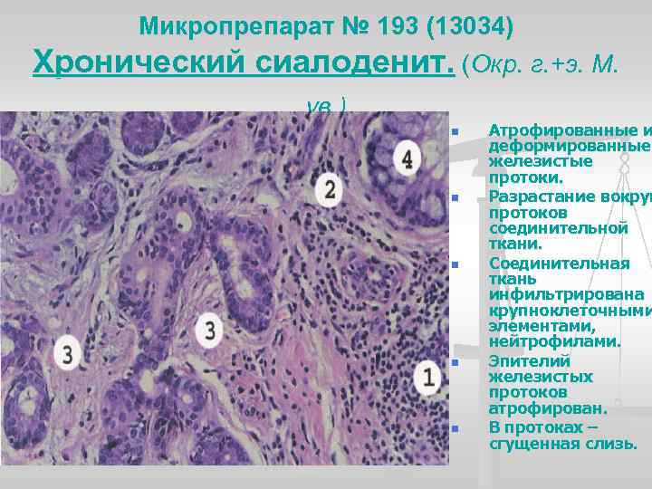 Микропрепарат № 193 (13034) Хронический сиалоденит. (Окр. г. +э. М. ув. ) n n