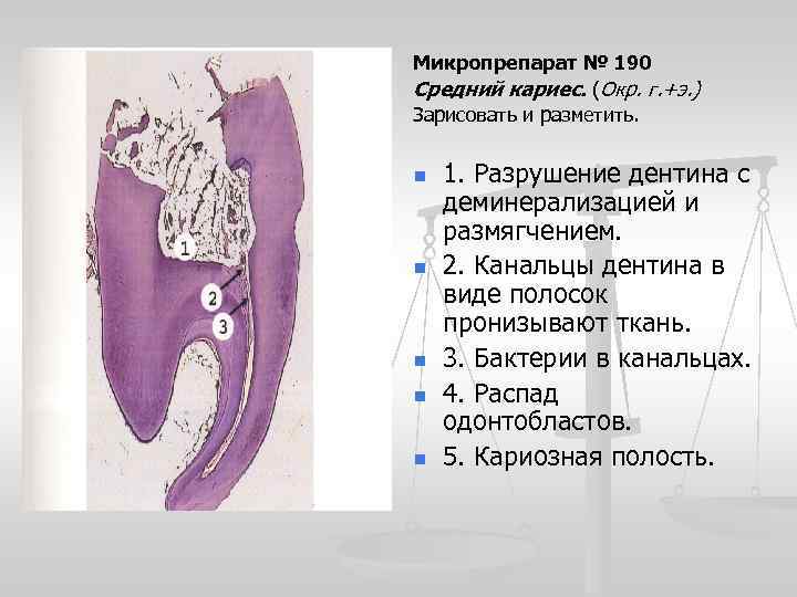 Микропрепарат № 190 Средний кариес. (Окр. г. +э. ) Зарисовать и разметить. n n