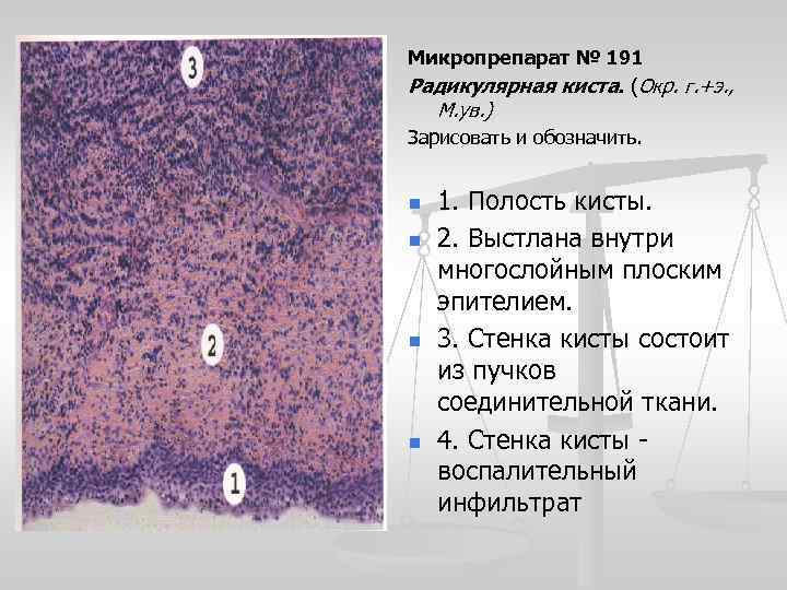 Микропрепарат № 191 Радикулярная киста. (Окр. г. +э. , М. ув. ) Зарисовать и