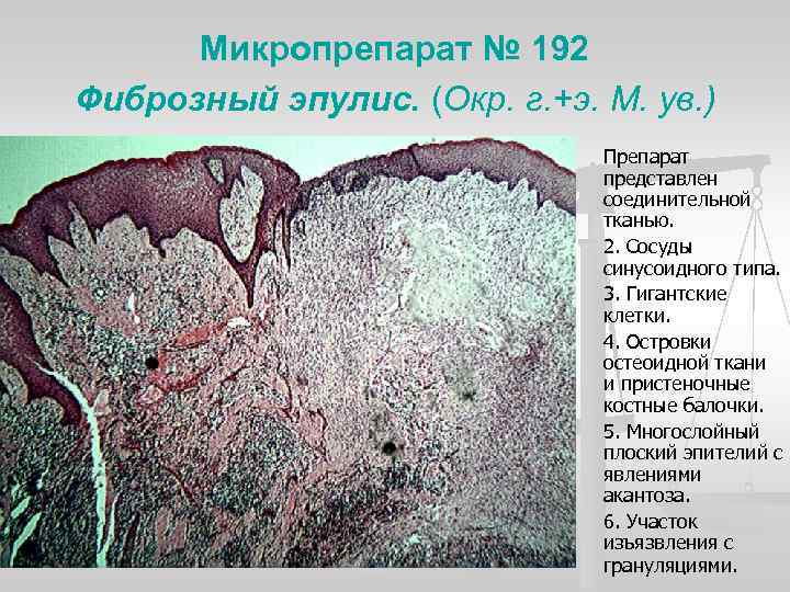 Микропрепарат № 192 Фиброзный эпулис. (Окр. г. +э. М. ув. ) n n n