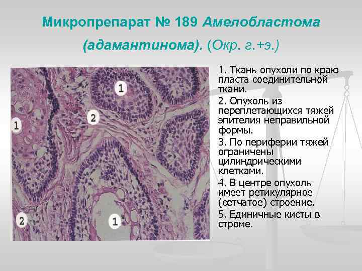 Микропрепарат № 189 Амелобластома (адамантинома). (Окр. г. +э. ) n n n 1. Ткань