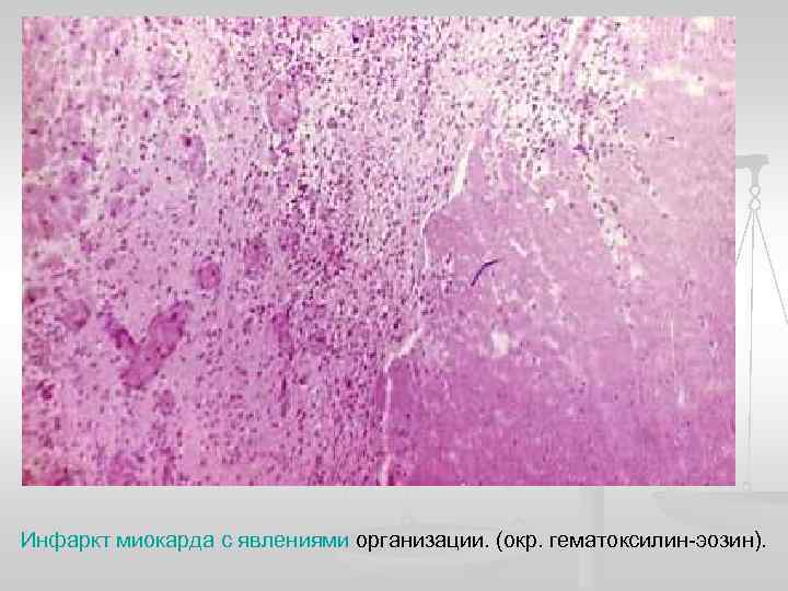 Инфаркт миокарда с явлениями организации. (окр. гематоксилин-эозин). 