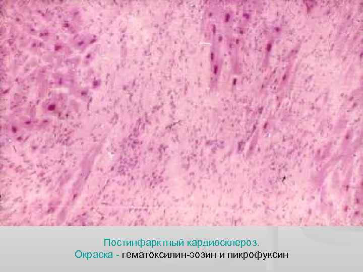 Постинфарктный кардиосклероз. Окраска - гематоксилин-эозин и пикрофуксин 