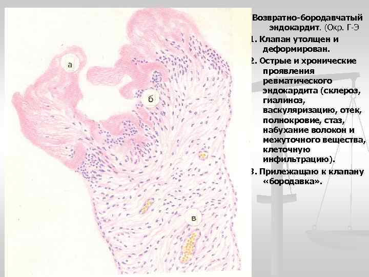 Возвратно-бородавчатый эндокардит. (Окр. Г-Э 1. Клапан утолщен и деформирован. 2. Острые и хронические проявления