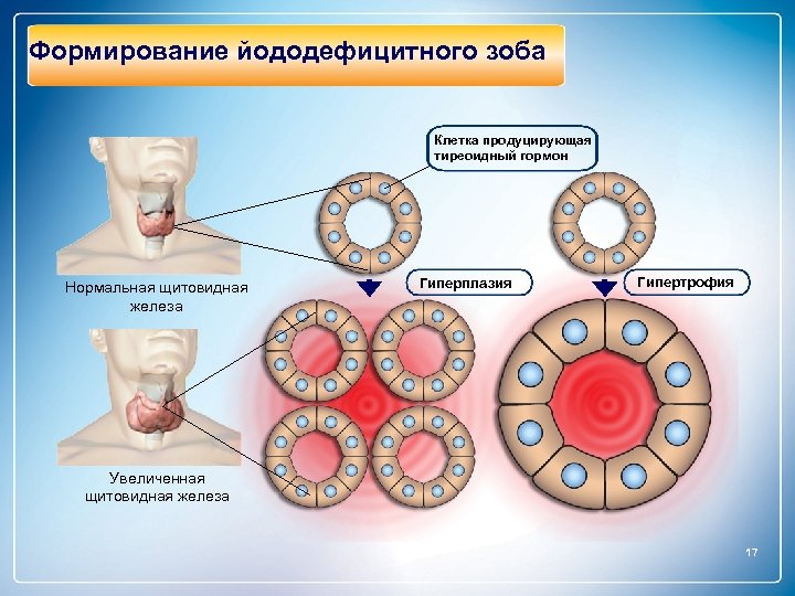 Формирование йододефицитного зоба Клетка продуцирующая тиреоидный гормон Нормальная щитовидная железа Гиперплазия Гипертрофия Увеличенная щитовидная