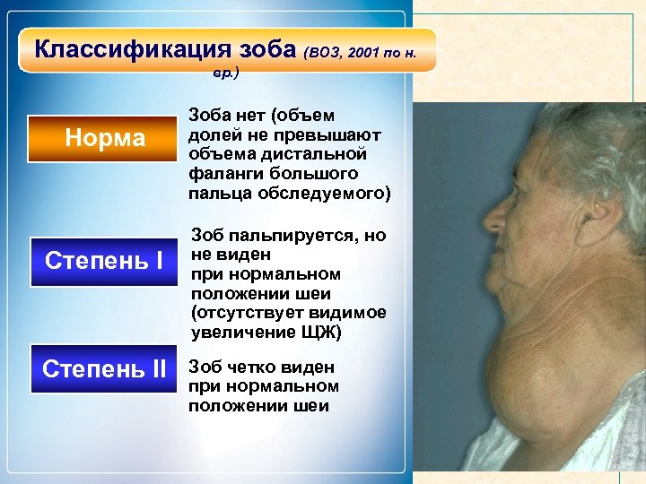 Классификация зоба (ВОЗ, 2001 по н. вр. ) Норма Степень II Зоба нет (объем