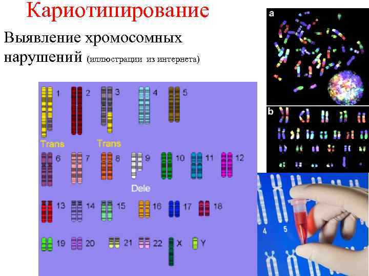  Кариотипирование Выявление хромосомных нарушений (иллюстрации из интернета) 