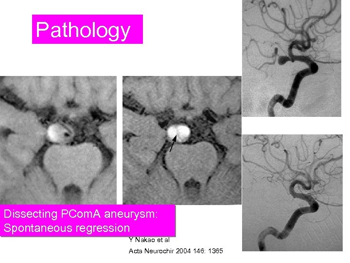 Pathology Dissecting PCom. A aneurysm: Spontaneous regression Y Nakao et al Acta Neurochir 2004