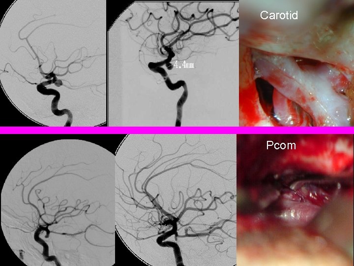 Carotid Pcom 