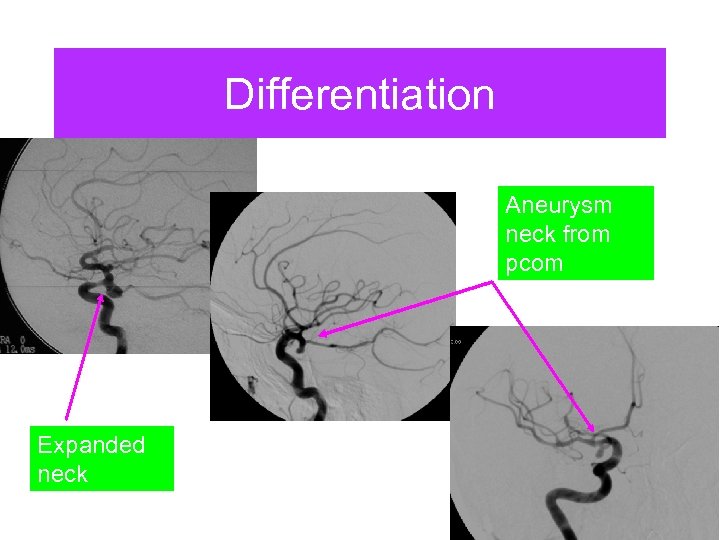 Differentiation Aneurysm neck from pcom Expanded neck 