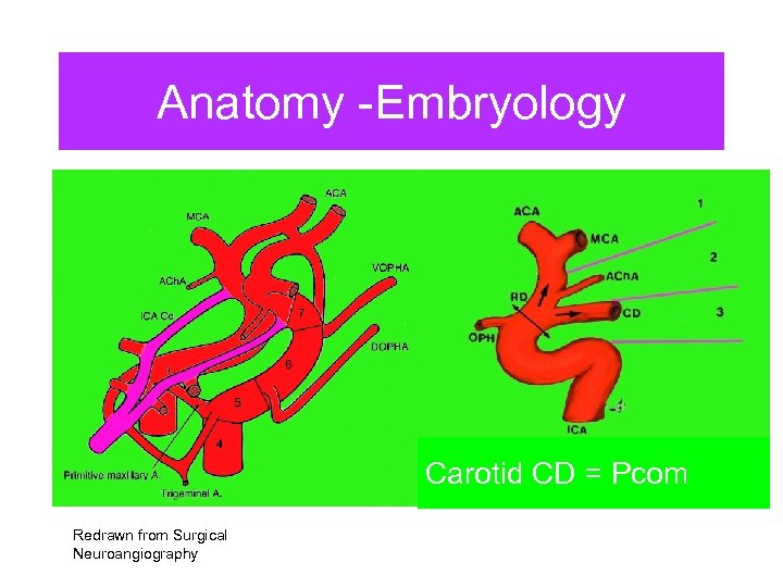 Anatomy -Embryology Carotid CD = Pcom Redrawn from Surgical Neuroangiography 