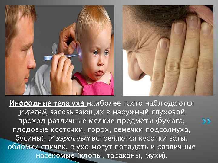 Инородные тела уха наиболее часто наблюдаются у детей, засовывающих в наружный слуховой проход различные
