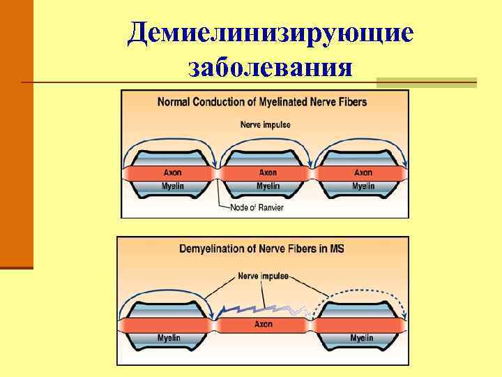 Демиелинизирующие заболевания 